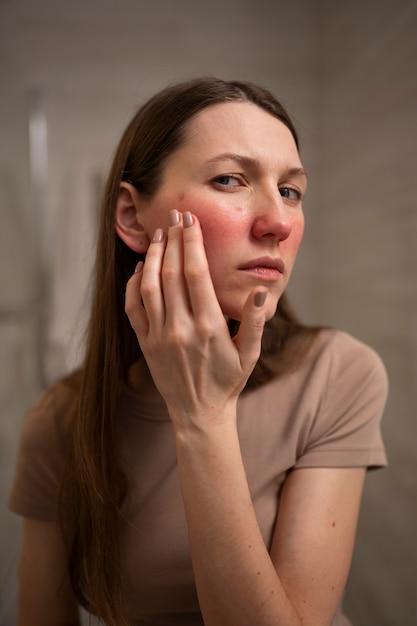 Mulher lidando com acne na pele do rosto